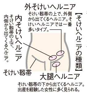 Q 左下腹部が腫れ そけいヘルニアと言われました 治療法は ニュース和歌山