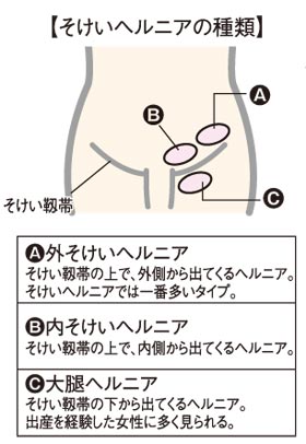 Q 足の付け根が腫れてきました 痛みはありません ニュース和歌山